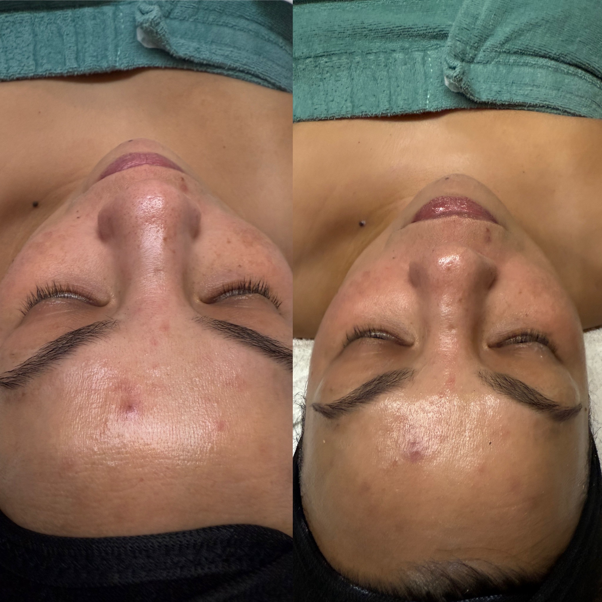 before and after facial satx