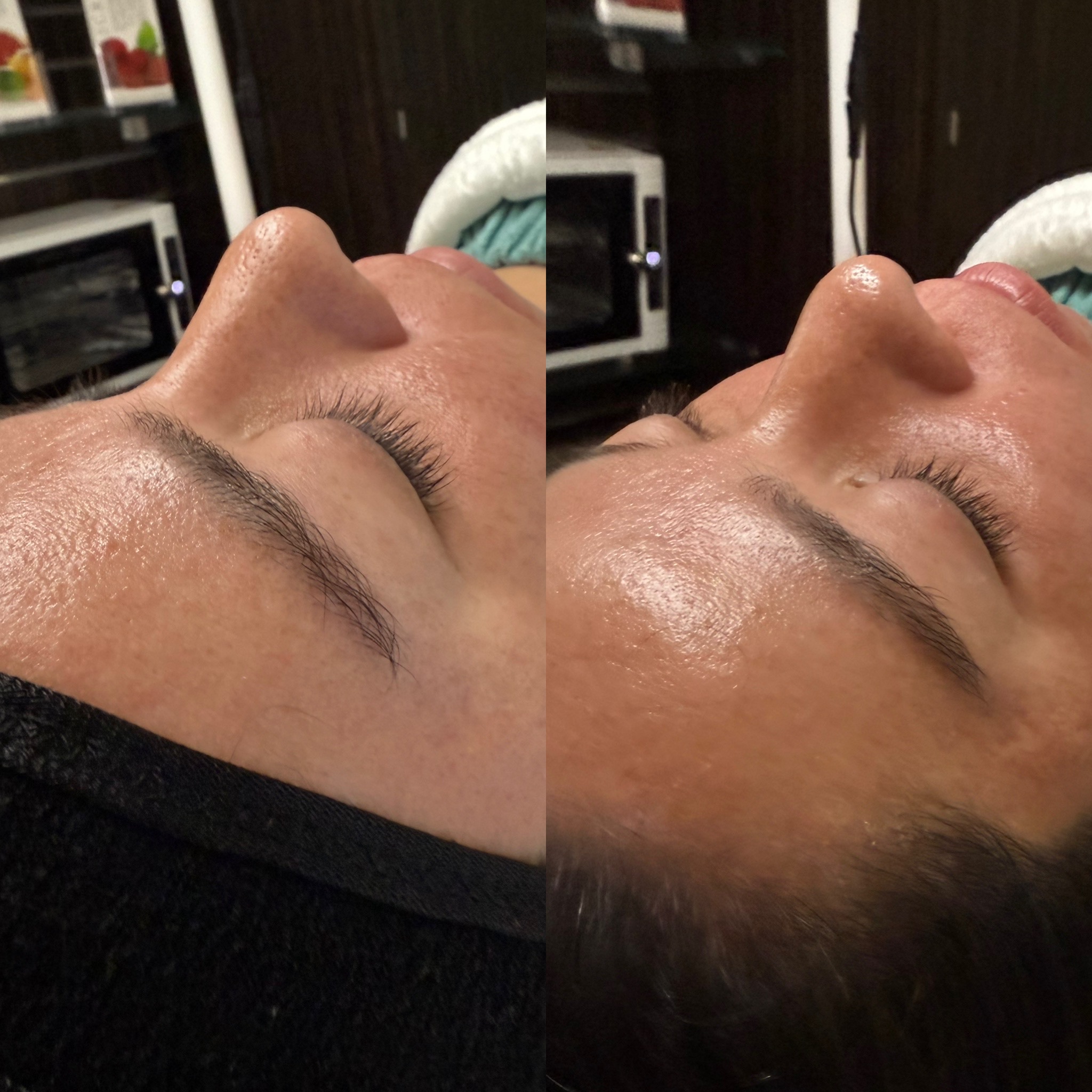 before and after facial